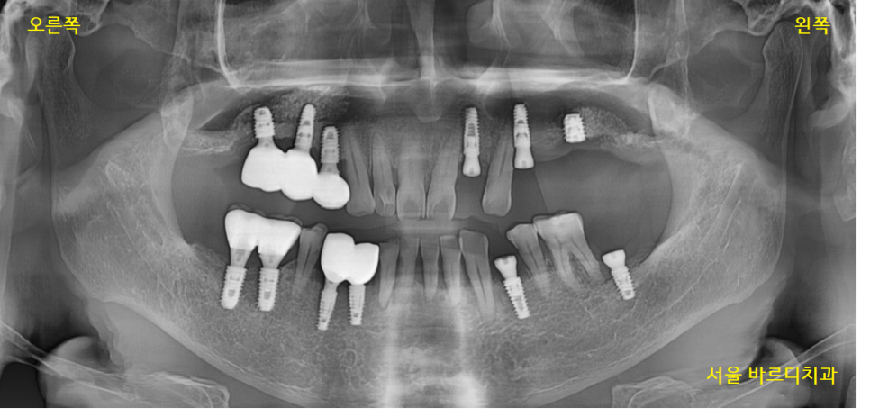 하남시청치과 디지털 임플란트를 고집하는 이유 관련 이미지 12