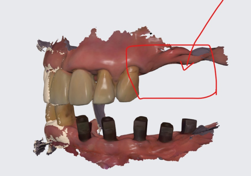 천호 디지털 가이드 임플란트, 일반 임플란트와 무슨 차이가 있나요? 관련 이미지 11