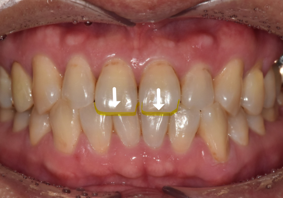 절단교합으로 인한 앞니 레진 깨짐, 교정 없이 해결한 사례 관련 이미지 1