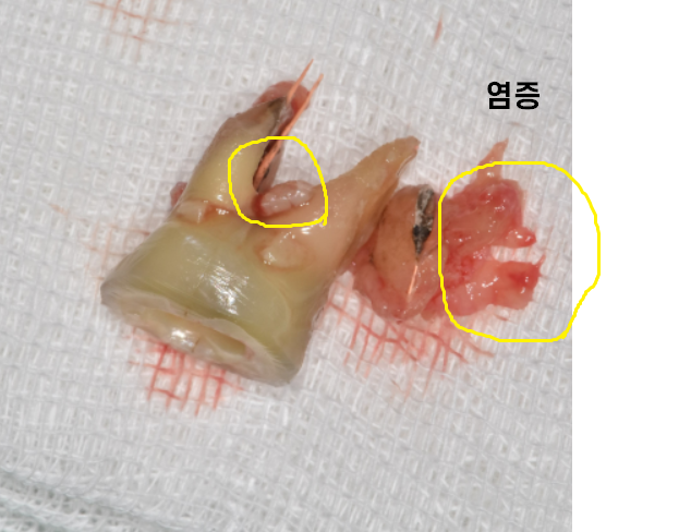 고덕동 임플란트 골이식 필수일까? 궁금증 여기 모두 있어요 관련 이미지 3