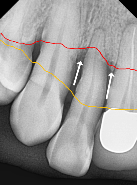 앞니 임플란트, 원내 기공소의 중요성을 아시나요? 관련 이미지 6