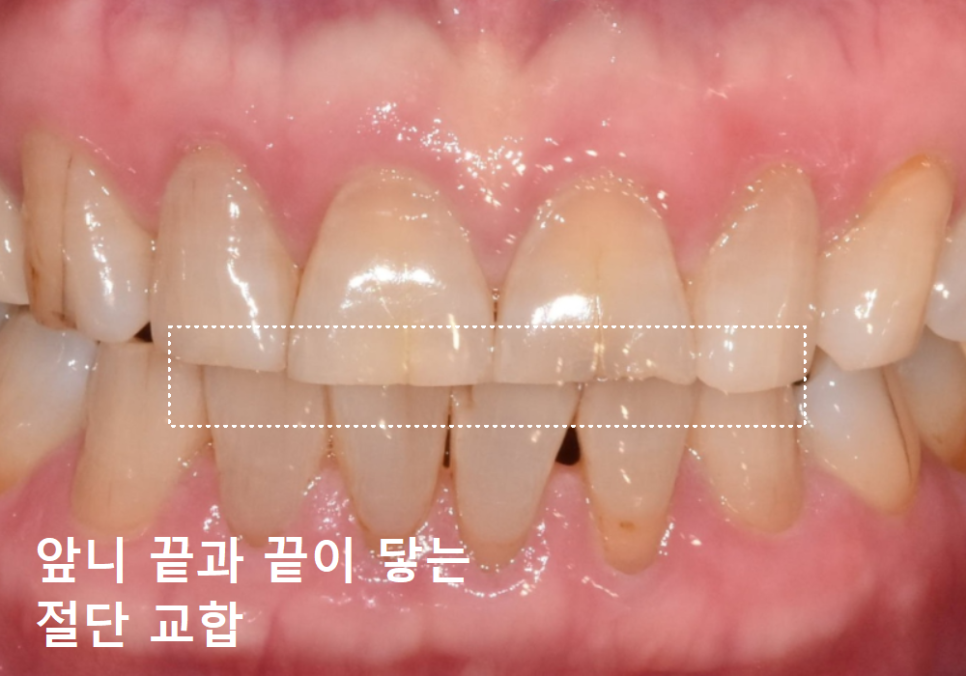 앞니 세로 줄, 똑같은 금이라도 진단 결과가 180도 다른 이유 관련 이미지 7