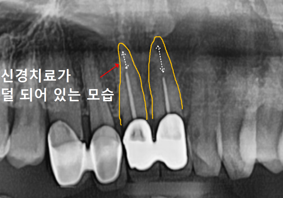 고덕동 심미 보철, 삐뚤어진 앞니, 교정 없이 바로잡은 비결 관련 이미지 5