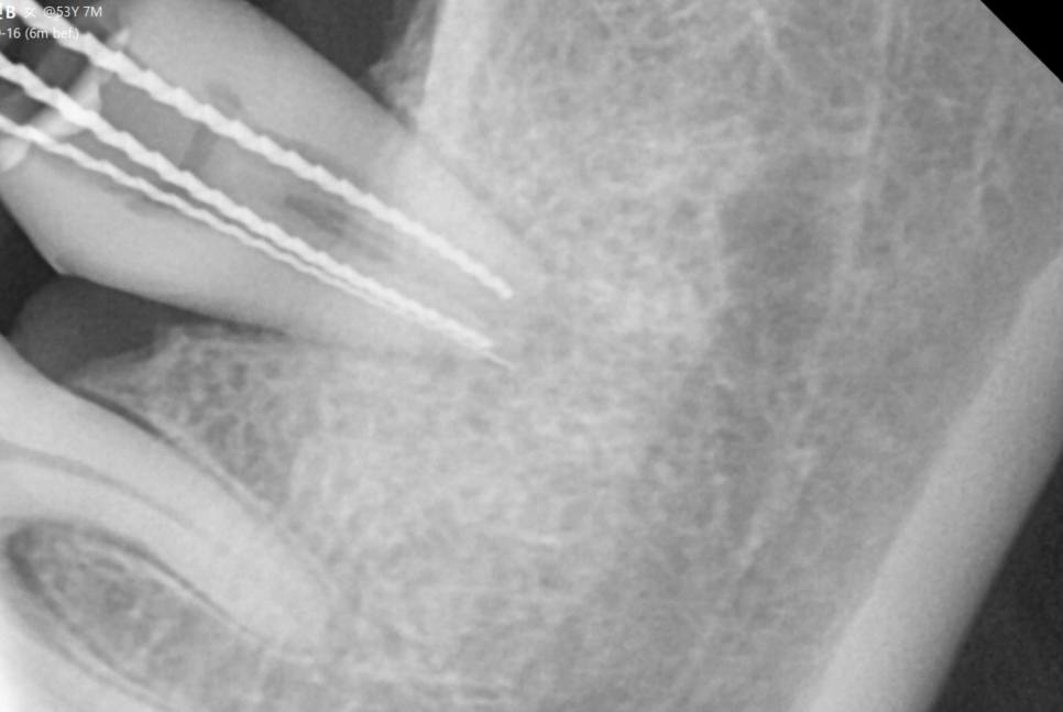 씹을때 찌릿 치아균열증후군 보이지 않아 위험합니다. 관련 이미지 5