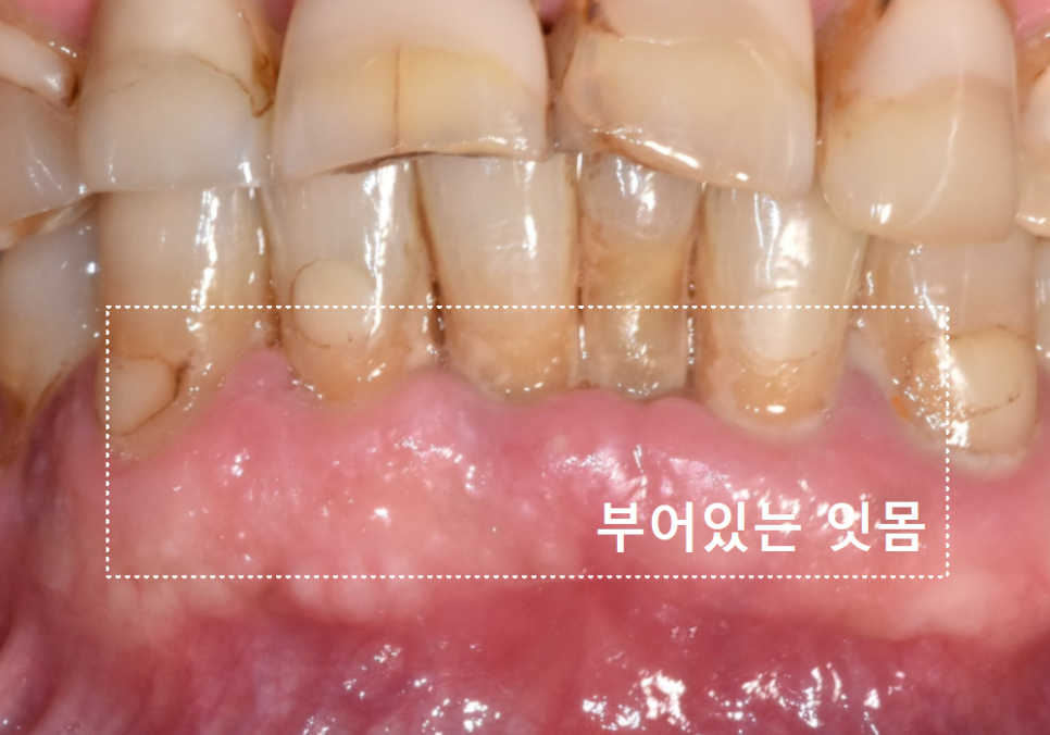 고덕동 어금니 사이 충치, 양치질 누구보다 열심히 하는데 왜 자꾸 생길까요? 관련 이미지 5