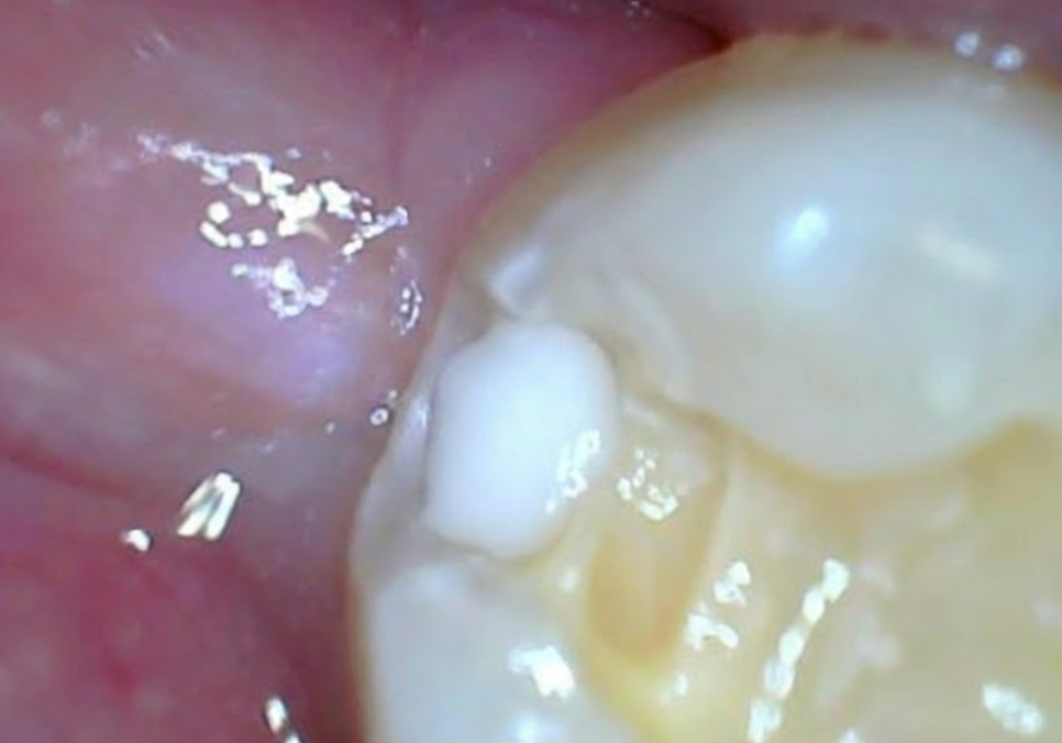 고덕동 사랑니 매복 발치, 안 아픈데 꼭 빼야 하나요? 관련 이미지 12
