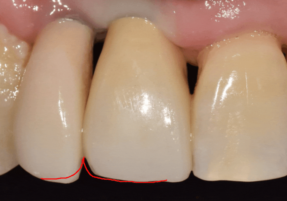 앞니 임플란트, 원내 기공소의 중요성을 아시나요? 관련 이미지 18