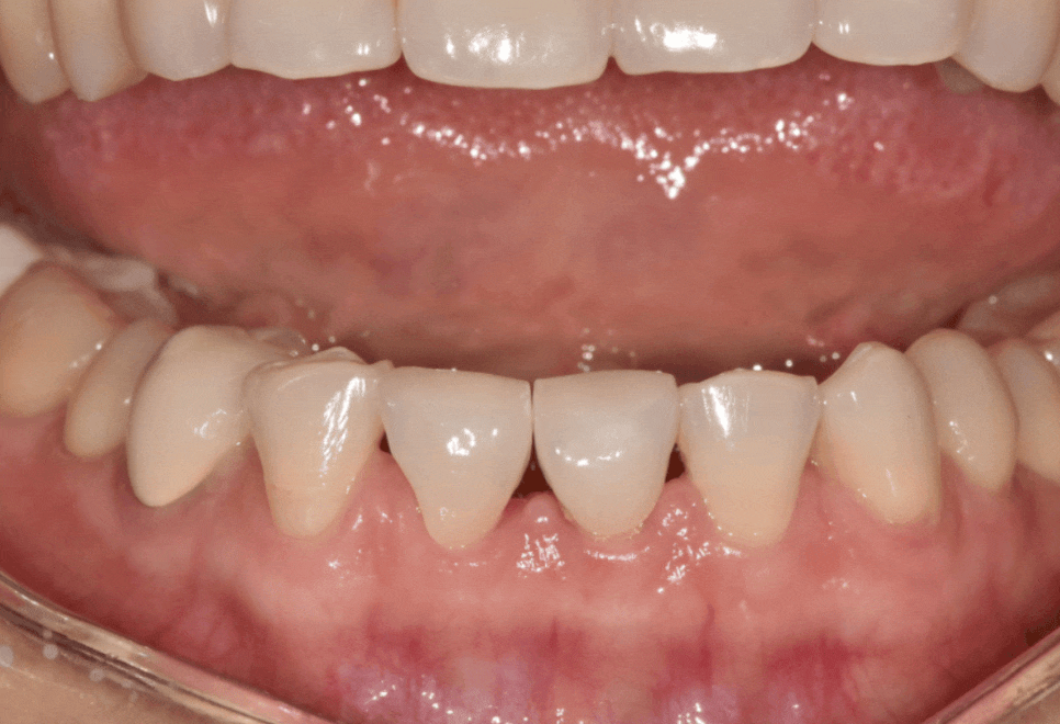 앞니 레진 떨어짐, 자꾸 반복된다면 관련 이미지 10