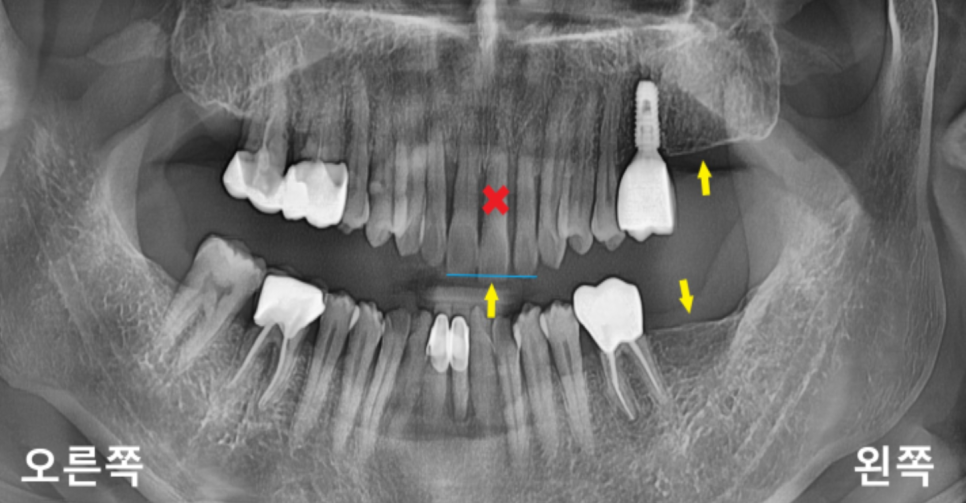 상일동치과 서울바르디치과 무절개 네비게이션 임플란트 치료증례 #3 관련 이미지 1