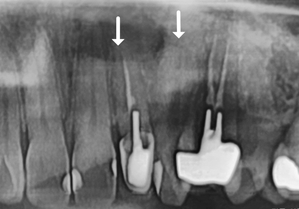 강동구 재신경치료, 왜 첫 치료보다 성공률이 낮다고 할까요? 관련 이미지 1
