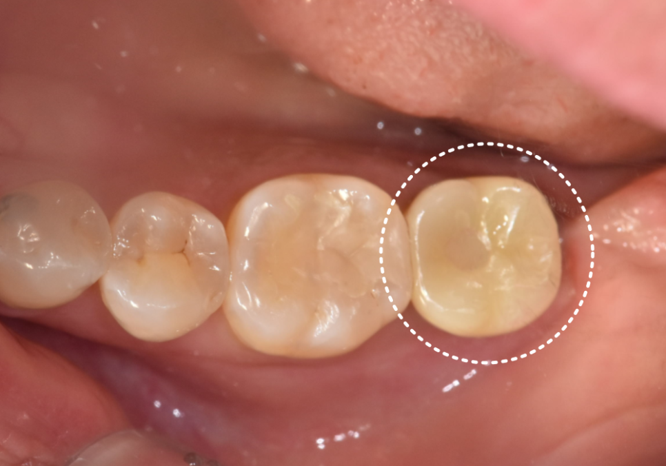 강동구 치아 뿌리 염증, 신경치료 한 치아인데도 아플 수 있나요? 관련 이미지 12