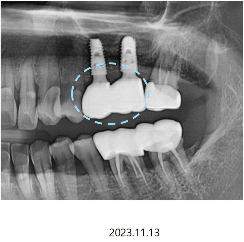 고덕동치과 서울바르디치과 무절개 네비게이션 임플란트 치료증례 #2 관련 이미지 19