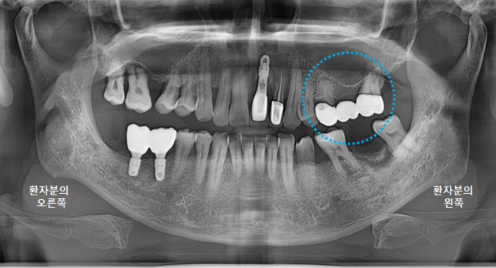 고덕동치과 서울바르디치과 전치부 및 구치부 임플란트 치료증례 #9 관련 이미지 14