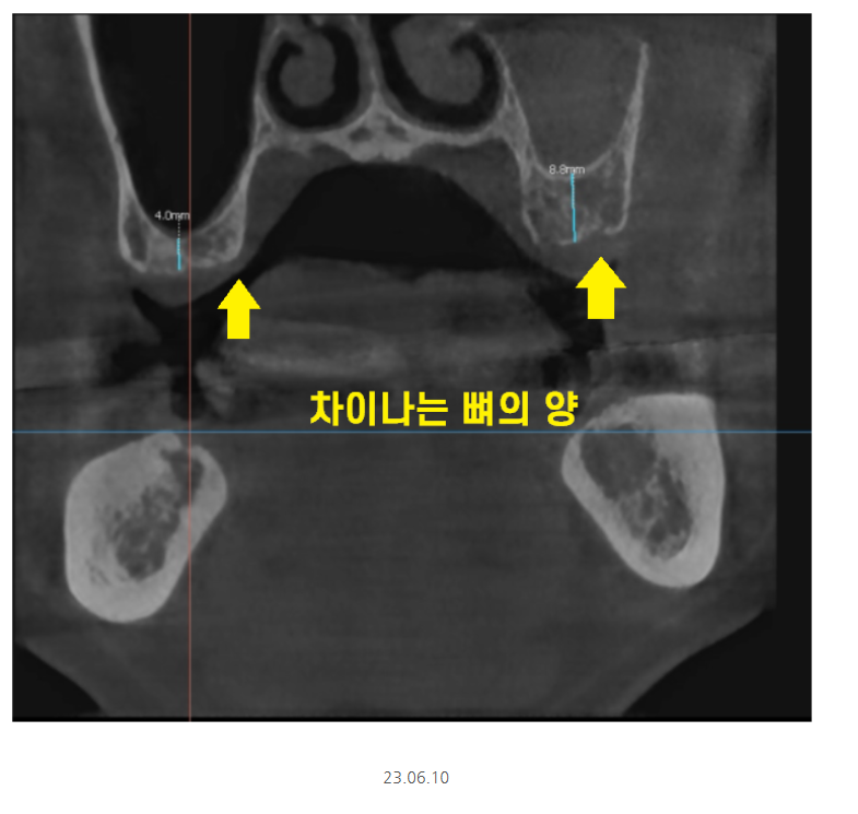 명일동 치과 임플란트 위아래 같이 할 수 있나요?? 관련 이미지 3