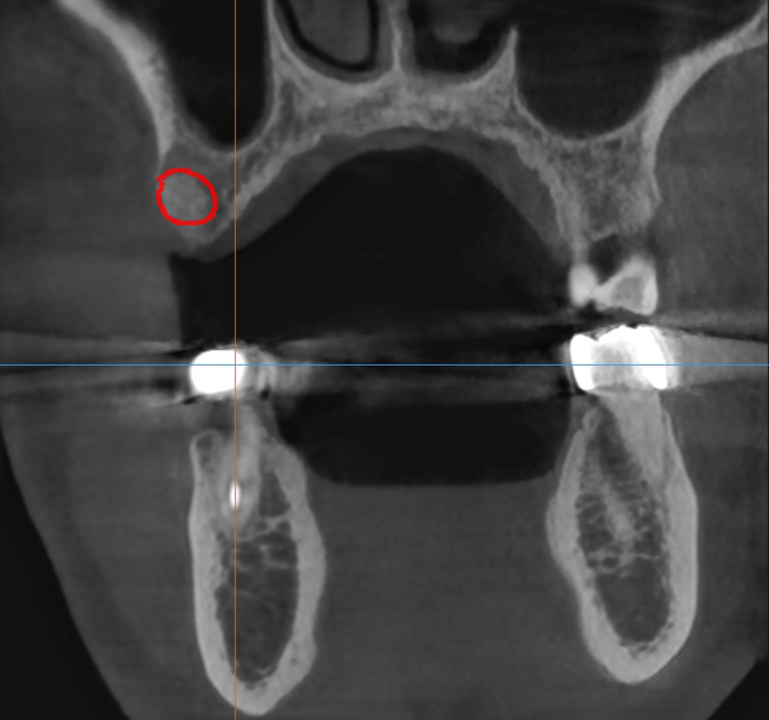 하남시청치과 신경치료 치아 발치 후 임플란트 했습니다. 관련 이미지 6