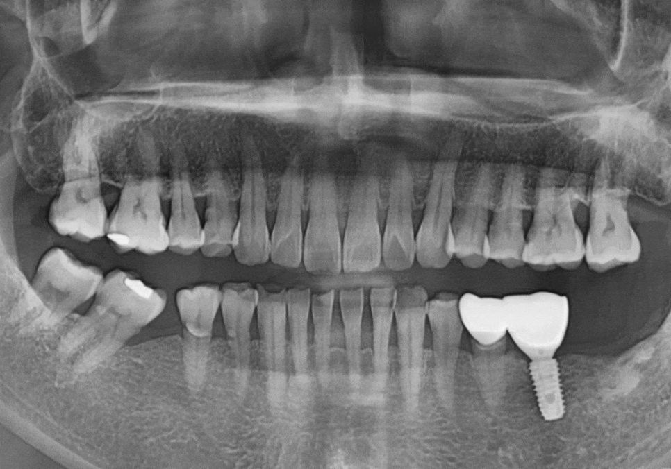 발치 후 빈 공간, 이 빼고 오래 냅두면 이렇게 됩니다. 관련 이미지 14