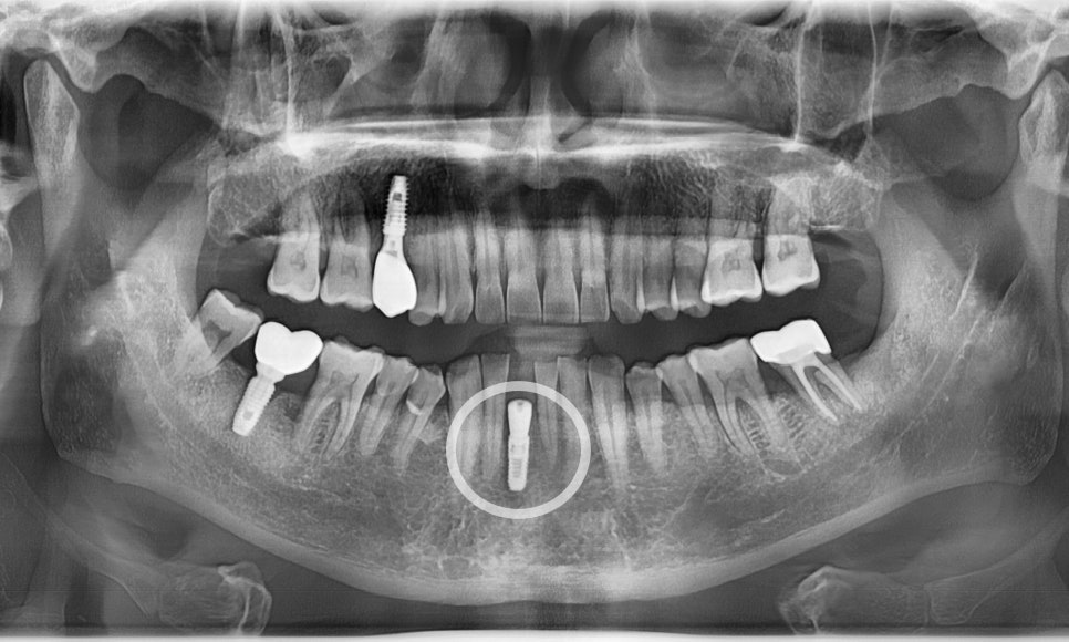 My Teeth Are Shaking So Much That Eating Is Uncomfortable—Is It Okay to Just Leave Them Alone? image 10