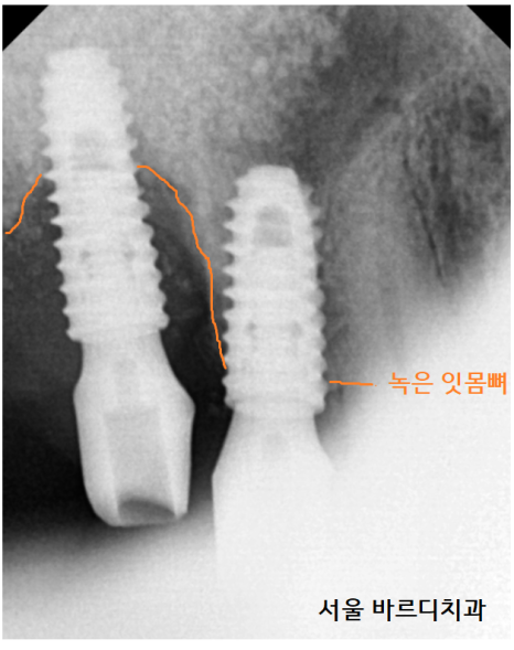 하남시청치과 디지털 임플란트를 고집하는 이유 관련 이미지 5