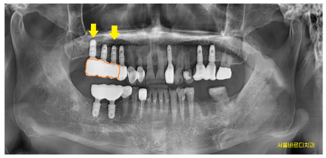 예전에 씌운 이 상악동 거상술 뼈이식 동반하여 임플란트 완료 관련 이미지 8