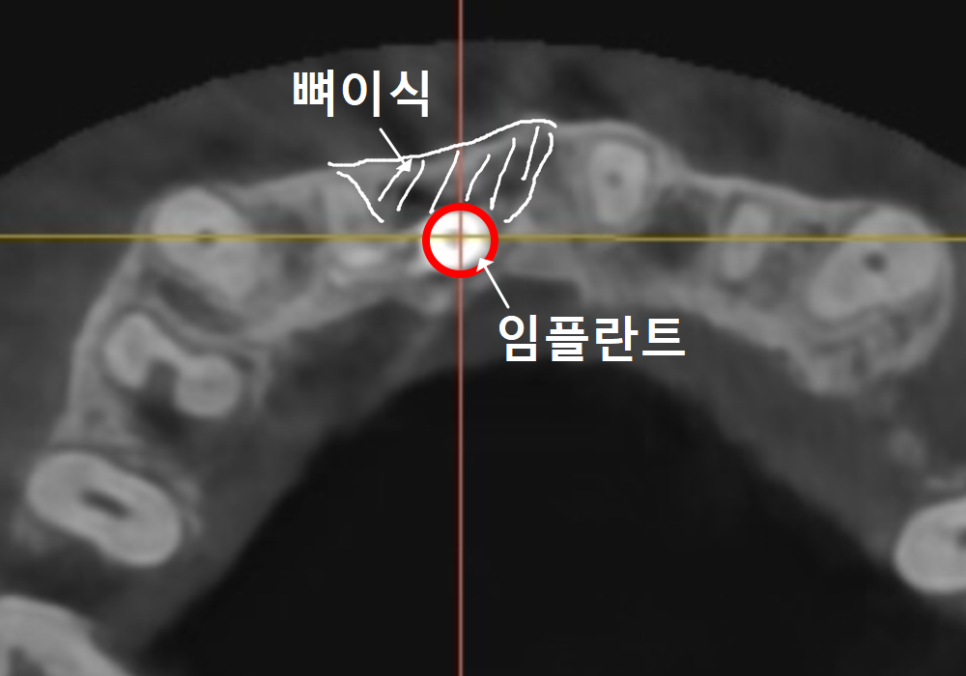 앞니 잇몸 꺼짐, 잇몸 이식 없이도 임플란트 할 수 있는 방법 공개합니다. 관련 이미지 8