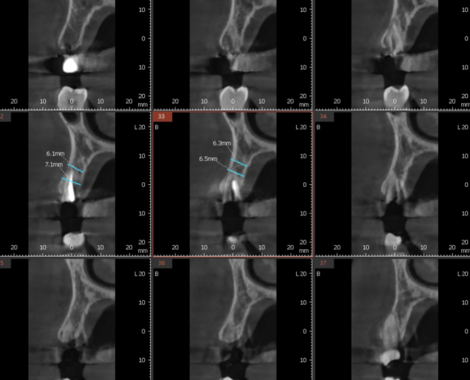 씌운 치아 부러짐 뿌리만 남은 경우 임플란트로 수복하기 관련 이미지 4