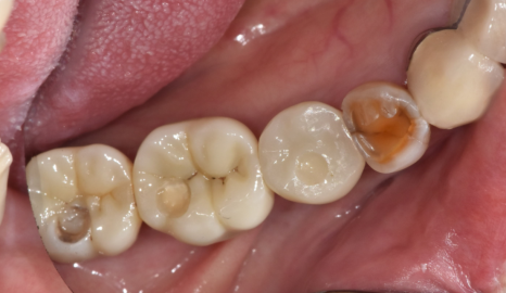 명일동 치과 임플란트 치료 기간 얼마나 걸릴까요??? 관련 이미지 12