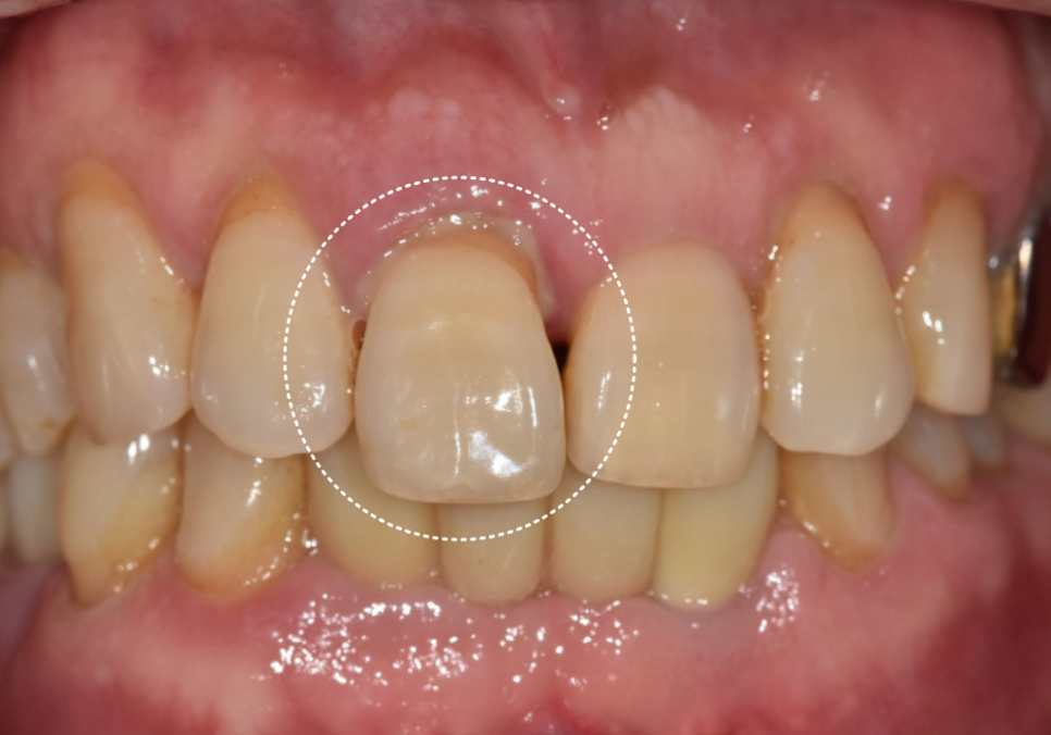 앞니 길어짐, 위 앞니가 점점 내려온다면? 관련 이미지 3