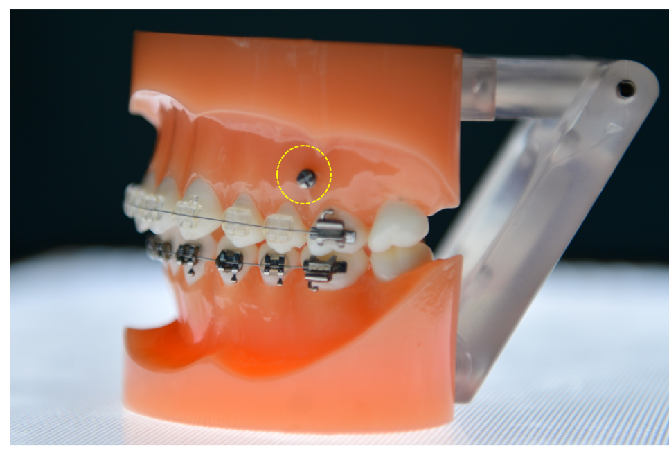 Answering Your Questions About Orthodontic Mini-Screw Placement. (Q&A) image 3