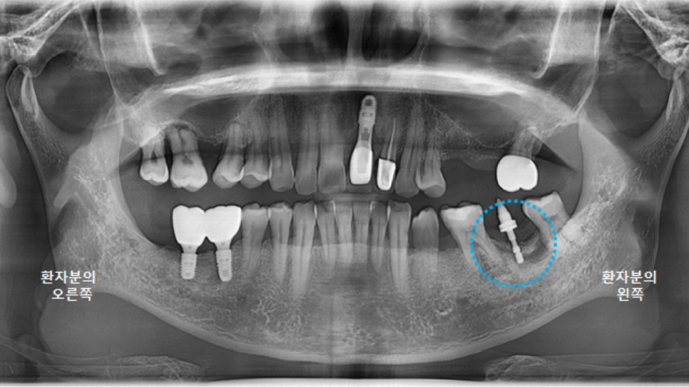 고덕동치과 서울바르디치과 전치부 및 구치부 임플란트 치료증례 #9 관련 이미지 12