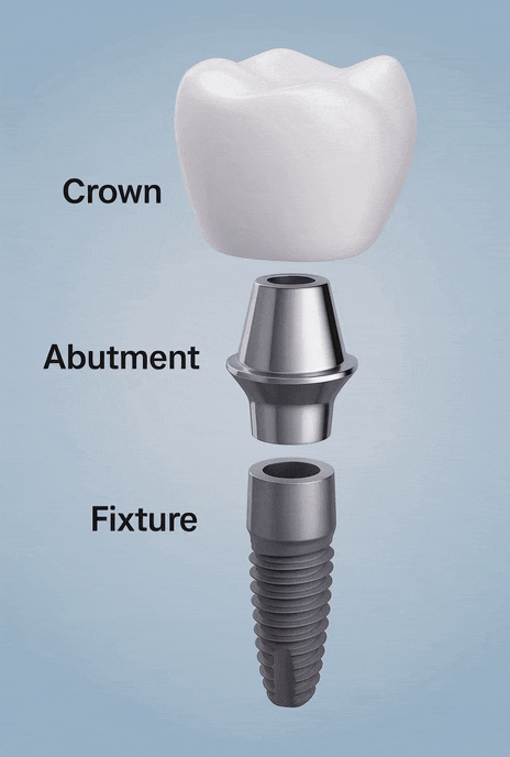 고덕동치과, 보험 임플란트? 추가 비용이 왜 나오는 거죠? 관련 이미지 2