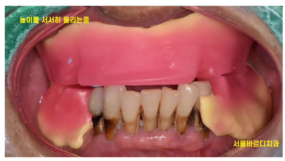 틀니 쓰다가 임플란트 어려움은 ? 높이를 높여주는게 킥!!! 관련 이미지 5