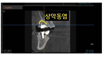 미사역 임플란트 상악동염으로 치아를 발치한 사연 관련 이미지 6