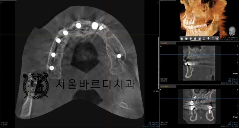 상일동역치과 서울바르디치과 무절개 네비게이션 임플란트 치료증례 #5 관련 이미지 11