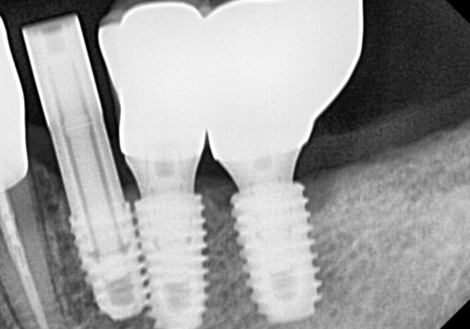 Godeok-dong Tooth Fracture: Check This Before Getting an Implant! Revealing the Criteria for Saving It image 12