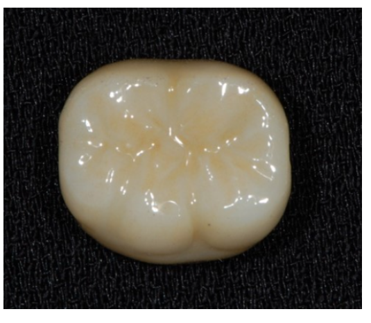건강보험 임플란트 지르코니아 크라운 확대 길동 치과에서! 관련 이미지 4