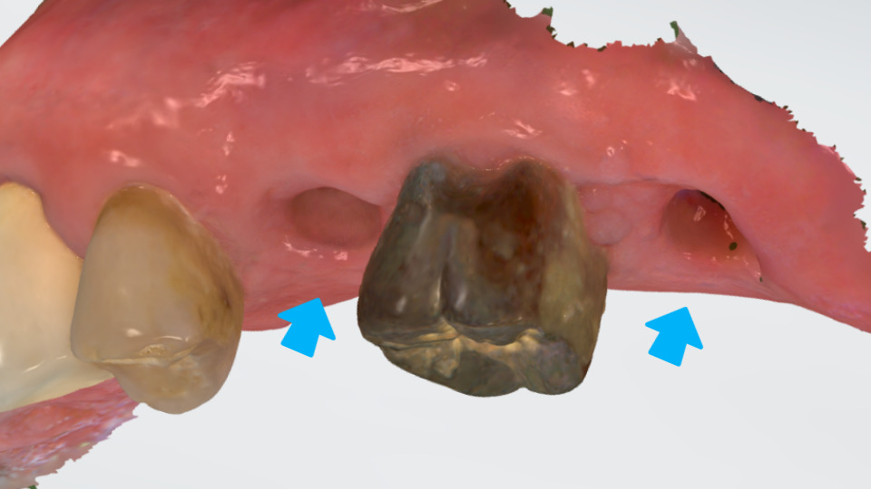 서울바르디치과 뿌리 끝 염증 심한 치아를 네비게이션 임플란트 #6 관련 이미지 15