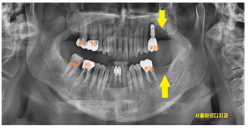 강동구 임플란트 위 아래 어금니 동시 식립으로 치료기간 대폭 축소 관련 이미지 2