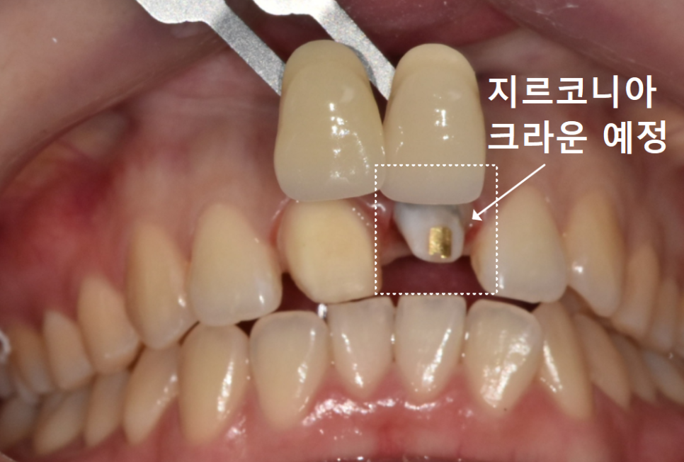 명일동 치과, 잇몸이 검게 변했다면? 앞니 변색 원인은 바로 관련 이미지 13