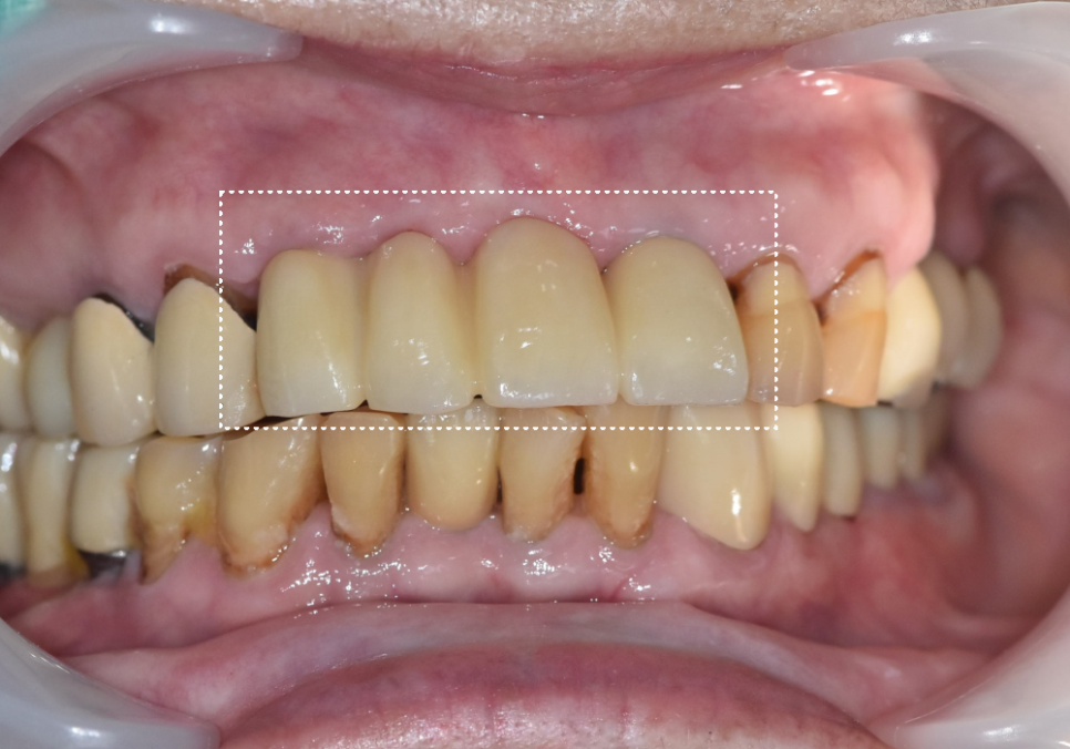 상일동 임플란트 심한 충치로 인한 치아 부러짐 해결한 사례 관련 이미지 6