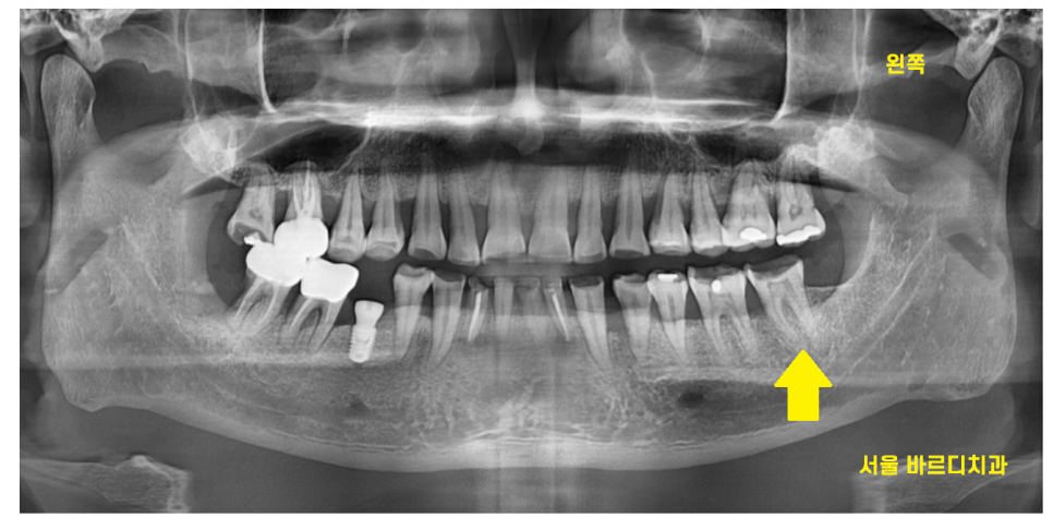 망월동 치과 신경치료 후 보철 꼭 씌워야 하나요?? 관련 이미지 2