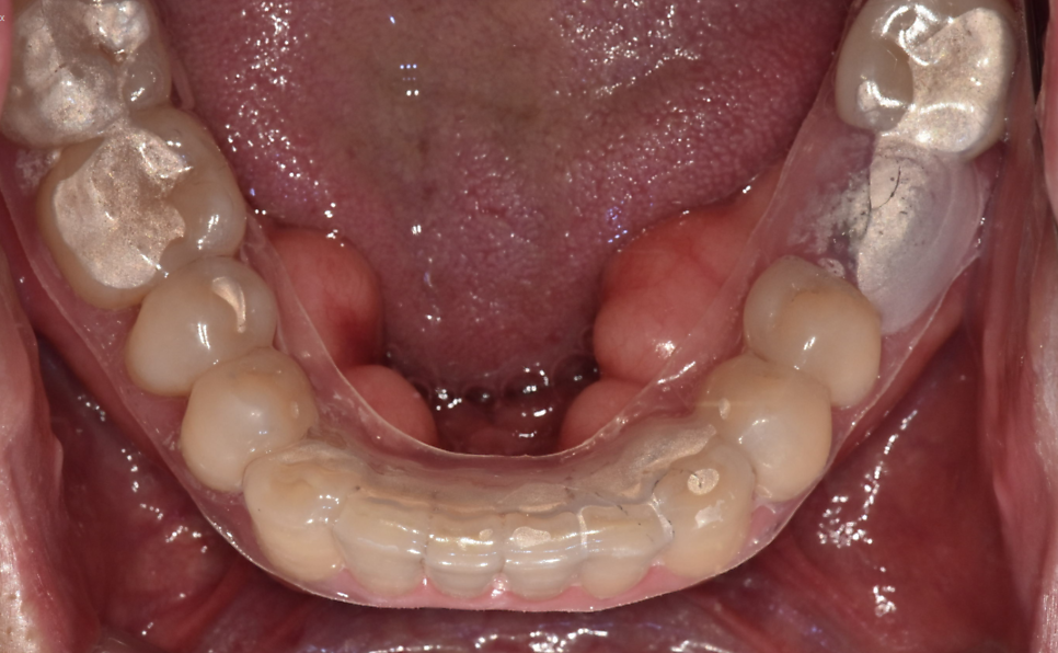 Two Types of Retainers Are Needed After Orthodontic Treatment: Bonded and Removable image 5
