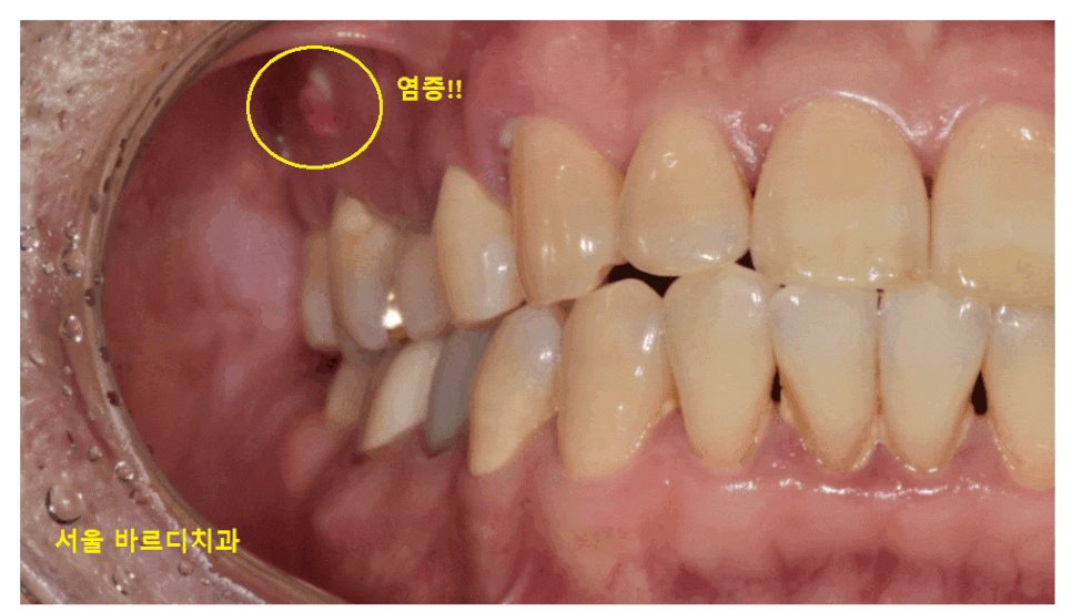 고덕역 임플란트 잇몸 뾰루지 뼈이식 두번 하여 해결했습니다. 관련 이미지 1