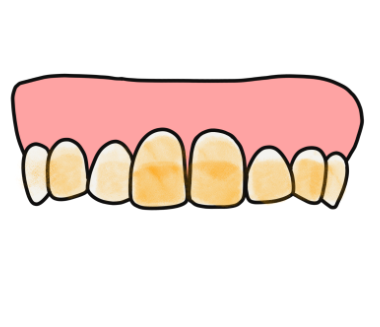 누런니 라미네이트와 미백중 뭐가 더 좋을까요?? 암사동 치과 관련 이미지 2