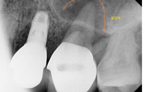 고덕동 치과 임플란트 뼈이식 꼭 해야하는건가요? 관련 이미지 4