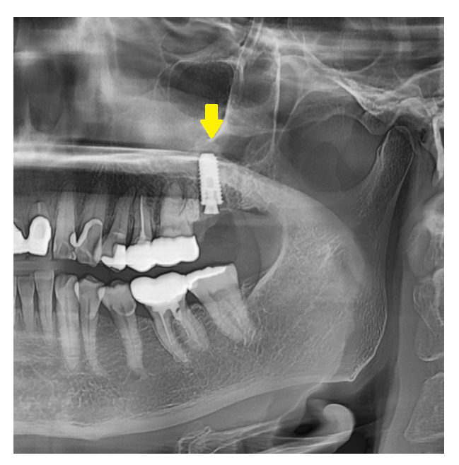 임플란트 시술 과정 총정리했습니다. 간접 경험 해볼까요? 관련 이미지 2