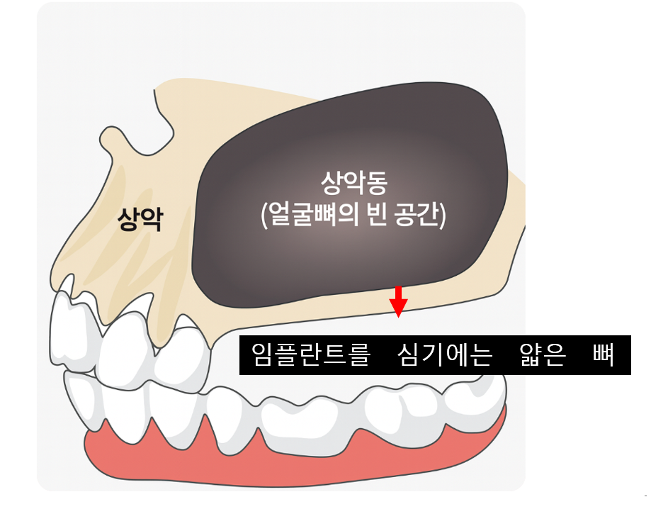 윗니 임플란트 상악동 부위 치아 염증으로 천공되었을 때 수술까지 관련 이미지 6