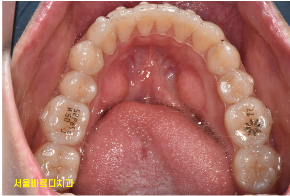미사 치아교정 군인도 할 수 있을까요?? 투명교정을 추천합니다. 관련 이미지 1