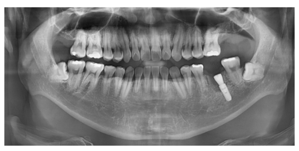 상일동 임플란트 수술 과정 시작부터 끝까지 따라와주세요! 관련 이미지 5