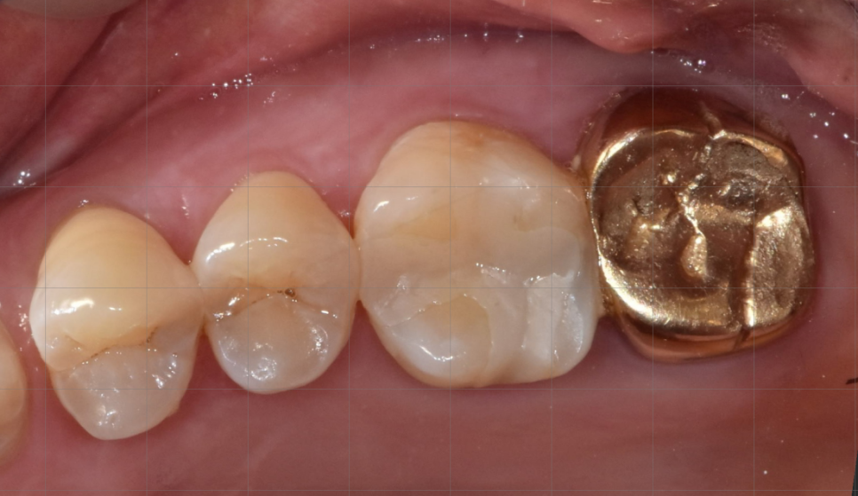골드 인레이 하방 이차우식 => E.max 인레이로 재치료 케이스 관련 이미지 4