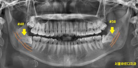 강동구 사랑니 묻혀있는 매복치아 꼼짝마!!! 뽑아줄테니까 관련 이미지 4